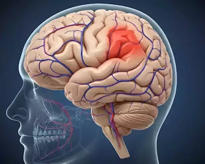 comprehensive-guide-to-brain-hemorrhage-treatment