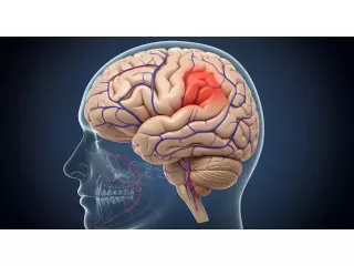 comprehensive-guide-to-brain-hemorrhage-treatment-small-0