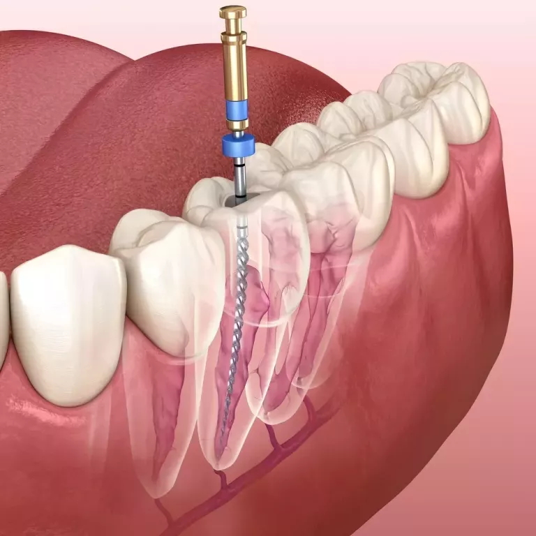 root-canal-treatment-in-new-town-creating-smiles-big-0