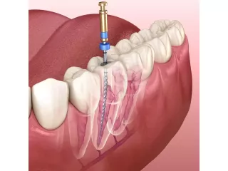 root-canal-treatment-in-new-town-creating-smiles-small-0