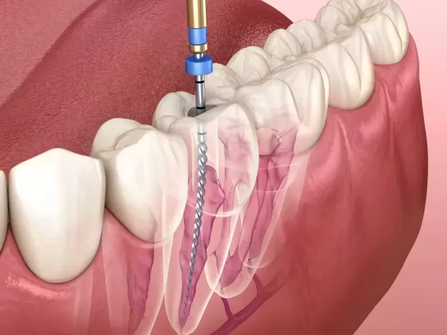 root-canal-treatment-in-new-town-creating-smiles