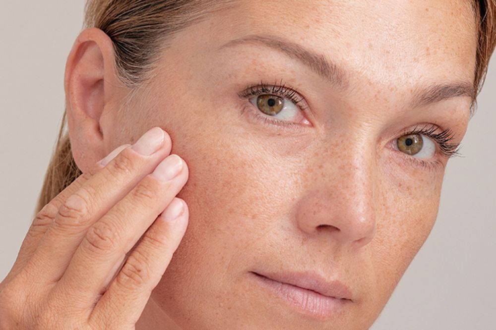 advanced-melasma-treatment-in-vasant-kunj-for-brighter-big-0