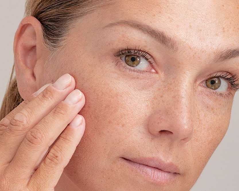 advanced-melasma-treatment-in-vasant-kunj-for-brighter