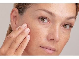 advanced-melasma-treatment-in-vasant-kunj-for-brighter-small-0