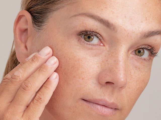 advanced-melasma-treatment-in-vasant-kunj-for-brighter