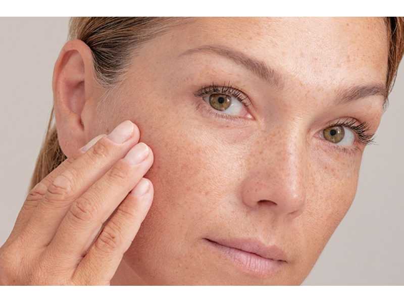 advanced-melasma-treatment-in-vasant-kunj-for-brighter-small-0