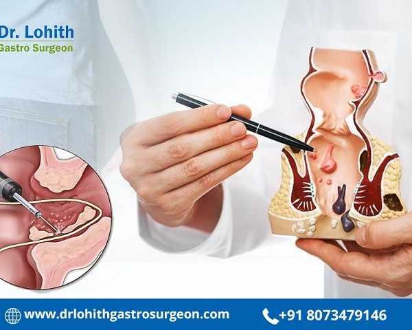 get-reliable-fistula-treatment-in-sarjapur-road