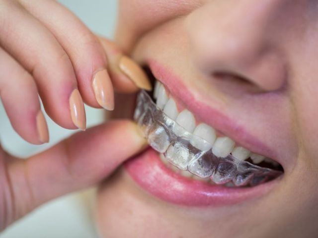 the-modern-way-to-achieve-a-confident-smile-through-aligners