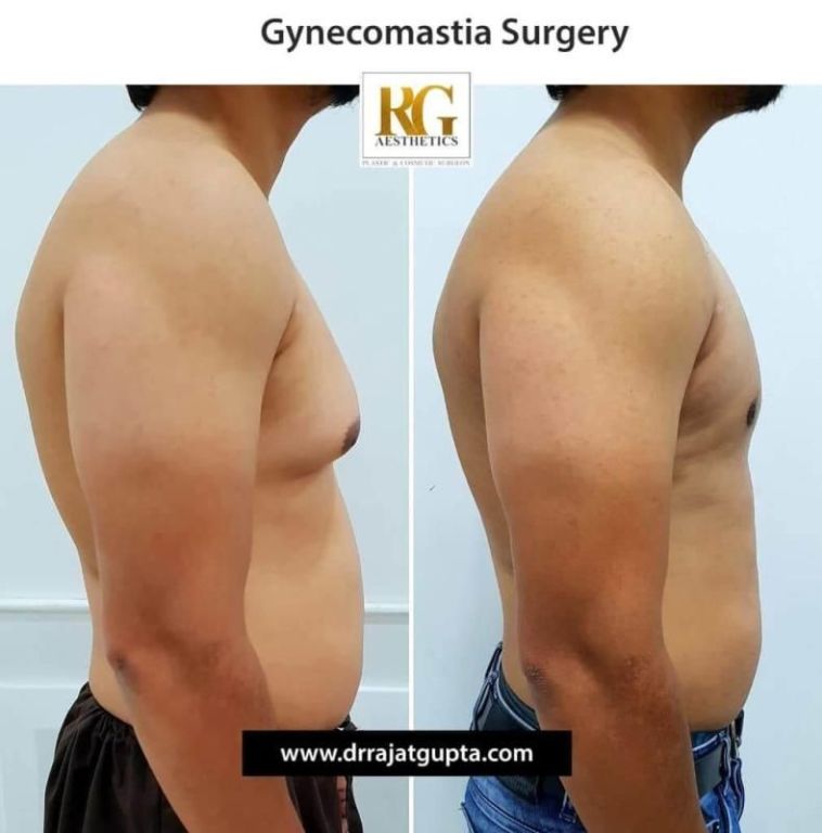 gynecomastia-before-and-after-what-results-really-look-like-big-0
