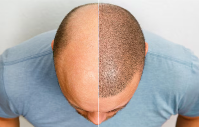 hair-transplant-cost-in-lucknow-affordable-price-best-results-big-0