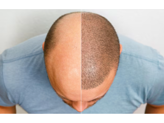 hair-transplant-cost-in-lucknow-affordable-price-best-results-small-0