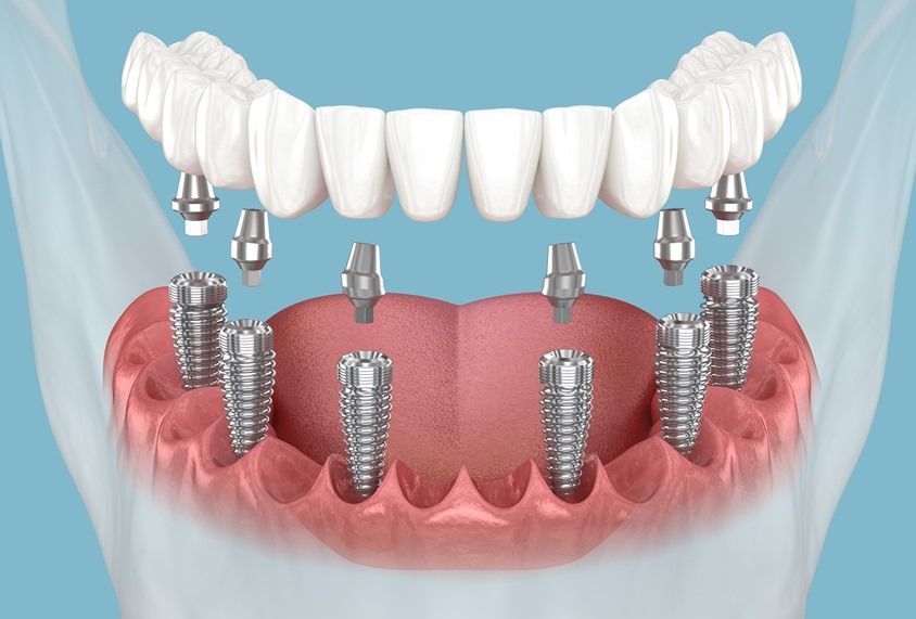 trusted-dental-implant-specialists-in-ahmedabad-tdwc-big-0