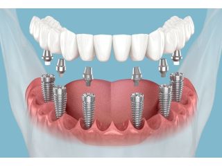 trusted-dental-implant-specialists-in-ahmedabad-tdwc-small-0