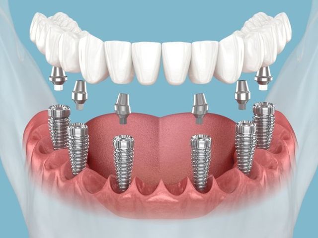 trusted-dental-implant-specialists-in-ahmedabad-tdwc