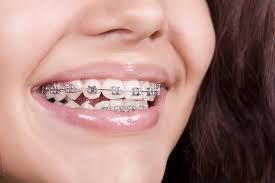 smile-confidently-with-dental-braces-in-chetla-big-0