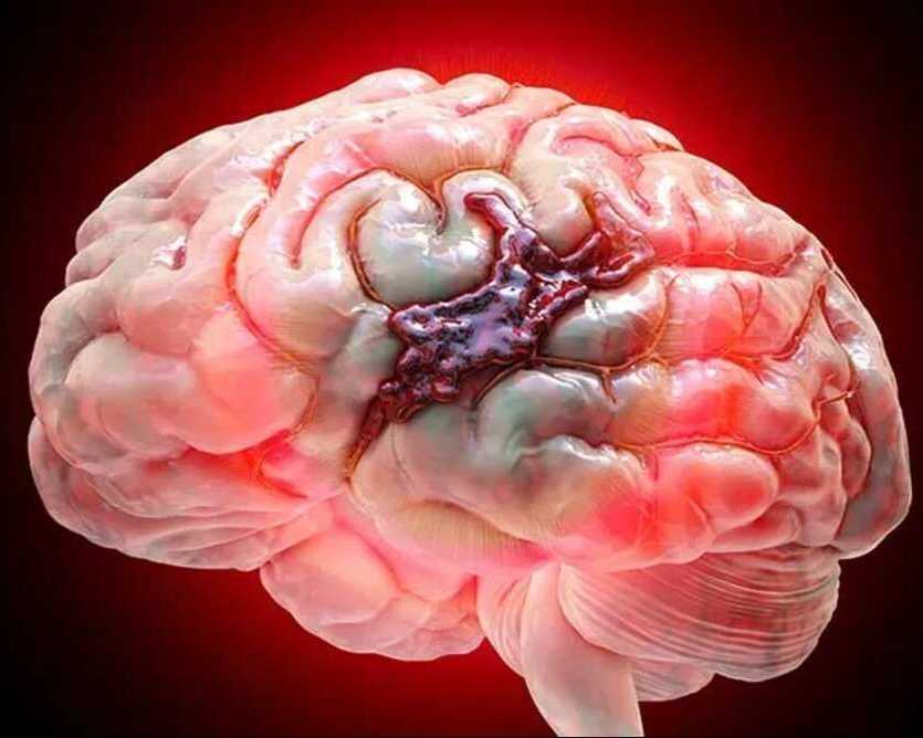 advanced-minimally-invasive-brain-hemorrhage-care-ir-facilities