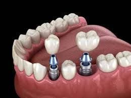 restore-your-smile-with-dental-implants-chetla-big-0