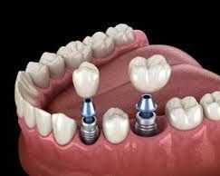 restore-your-smile-with-dental-implants-chetla