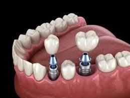 restore-your-smile-with-dental-implants-chetla-big-0