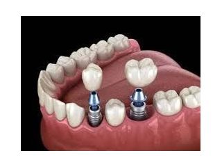 restore-your-smile-with-dental-implants-chetla-small-0