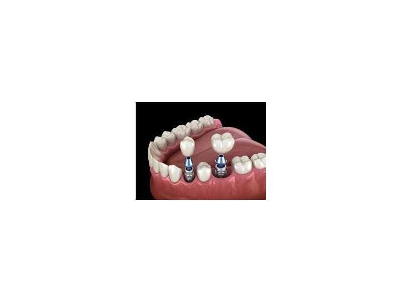 restore-your-smile-with-dental-implants-chetla-small-0