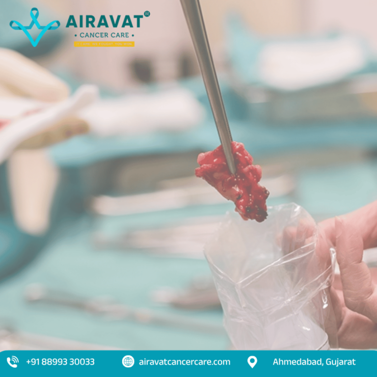 trusted-cancer-treatment-by-the-best-cancer-surgeon-in-ahmedabad-big-0
