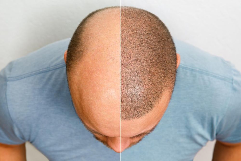 hair-transplant-surgery-in-delhi-natural-permanent-results-big-0