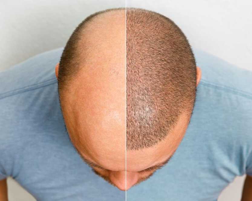 hair-transplant-surgery-in-delhi-natural-permanent-results