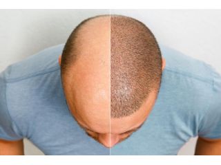hair-transplant-surgery-in-delhi-natural-permanent-results-small-0