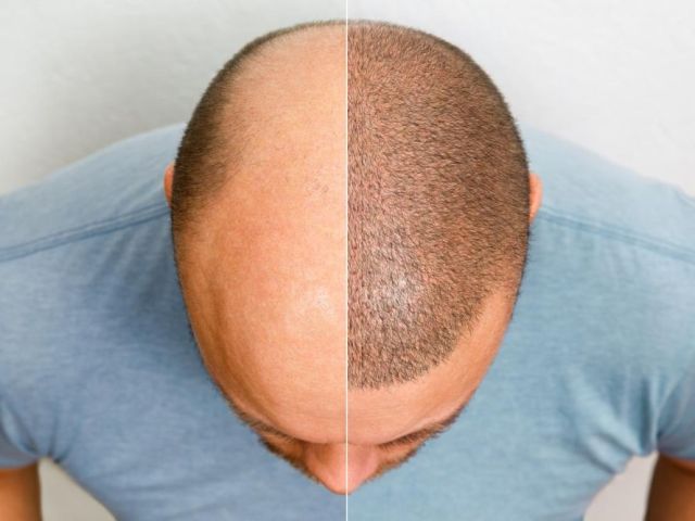 hair-transplant-surgery-in-delhi-natural-permanent-results