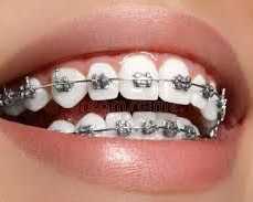 expert-dental-braces-treatment-centre-in-chetla