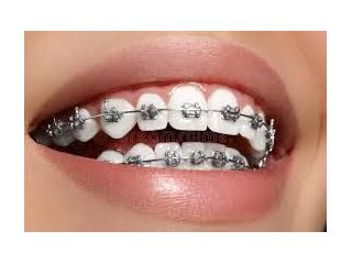 expert-dental-braces-treatment-centre-in-chetla-small-0