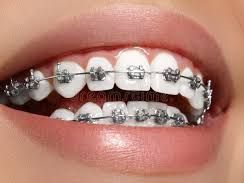 expert-dental-braces-treatment-centre-in-chetla