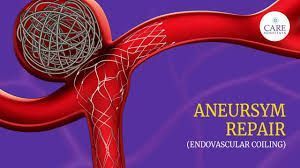 advanced-aneurysm-endovascular-coiling-treatment-at-ir-facilities-big-0