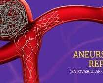 advanced-aneurysm-endovascular-coiling-treatment-at-ir-facilities