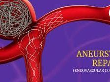 advanced-aneurysm-endovascular-coiling-treatment-at-ir-facilities