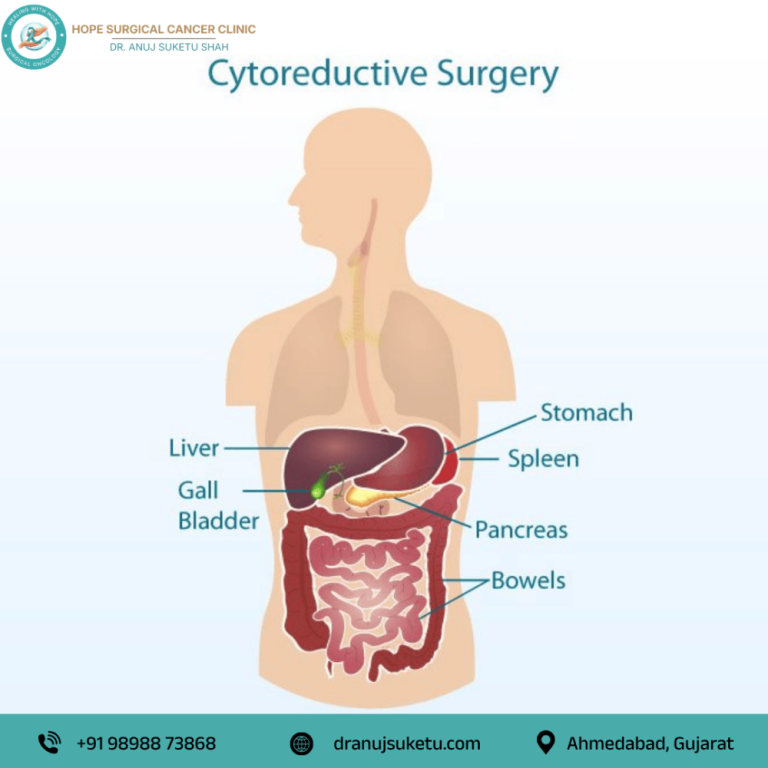cytoreductive-surgery-in-ahmedabad-for-abdominal-cancer-big-0