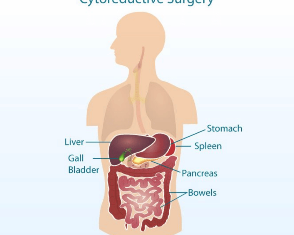 cytoreductive-surgery-in-ahmedabad-for-abdominal-cancer