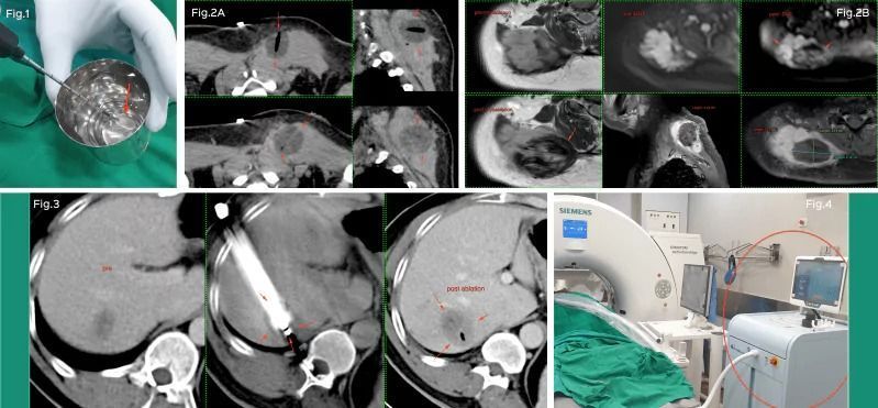 advanced-cryoablation-therapy-for-tumours-picture-this-big-0