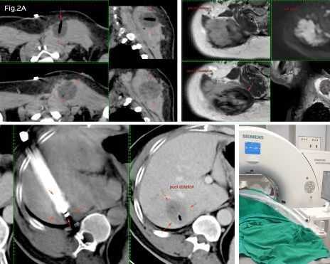 advanced-cryoablation-therapy-for-tumours-picture-this