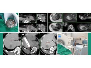 advanced-cryoablation-therapy-for-tumours-picture-this-small-0