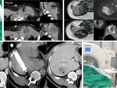 advanced-cryoablation-therapy-for-tumours-picture-this