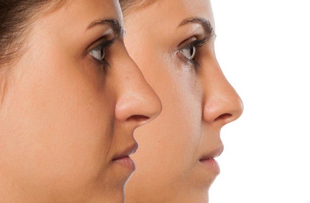nose-reshaping-in-andheri-expert-rhinoplasty-surgeon-big-0