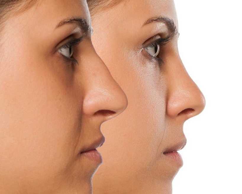 nose-reshaping-in-andheri-expert-rhinoplasty-surgeon