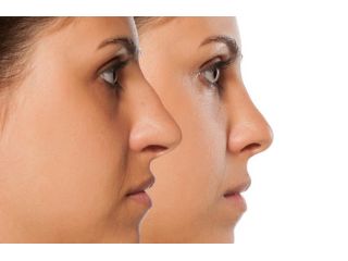 nose-reshaping-in-andheri-expert-rhinoplasty-surgeon-small-0