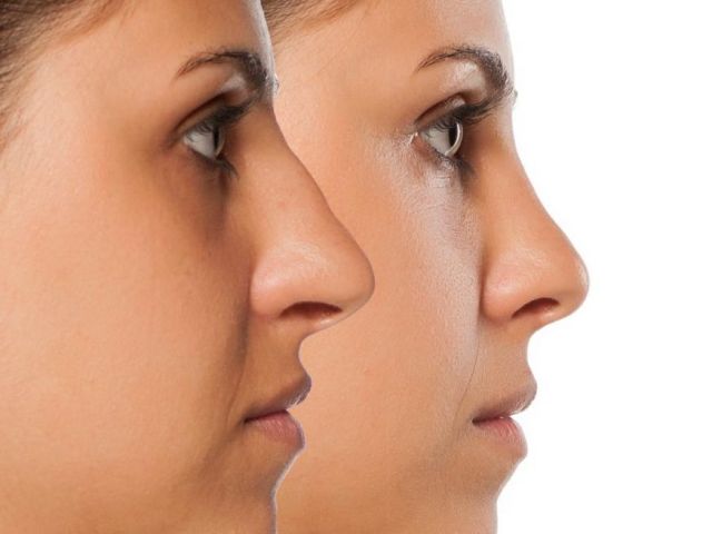 nose-reshaping-in-andheri-expert-rhinoplasty-surgeon