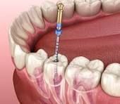 advanced-root-canal-treatment-clinic-in-chetla-big-0