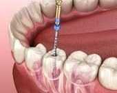 advanced-root-canal-treatment-clinic-in-chetla