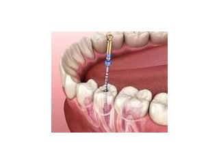 advanced-root-canal-treatment-clinic-in-chetla-small-0