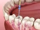 advanced-root-canal-treatment-clinic-in-chetla